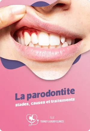 La parodontite : stades, causes et traitements