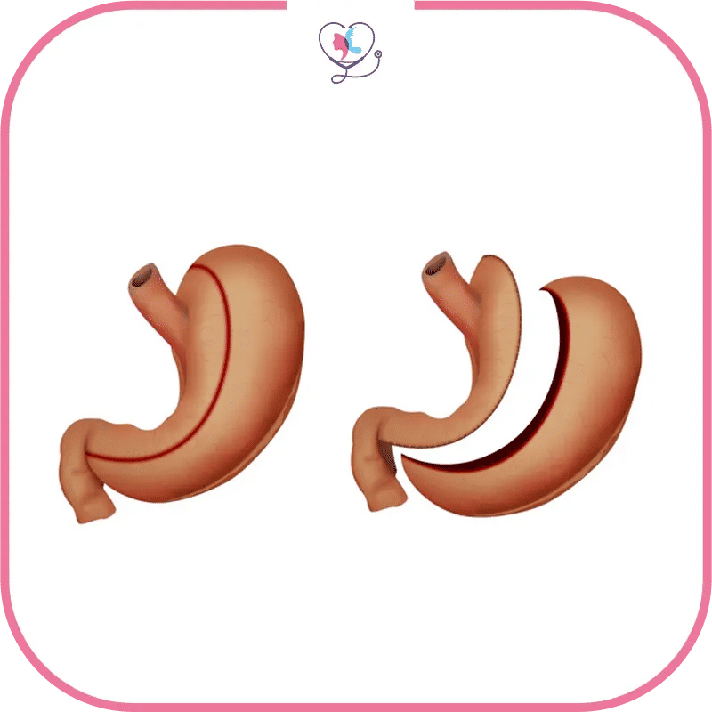sleeve turquie prix - sleeve gastrectomie prix