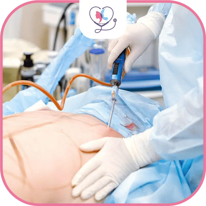 Liposuccion vs abdominoplastie : Durée de récupération