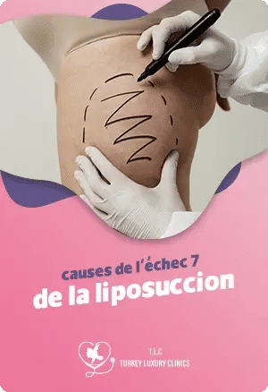 10 causes de l'échec de la liposuccion