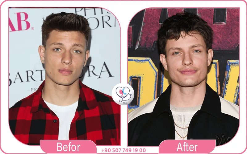 Matt Rife Plastic Surgery Before and After