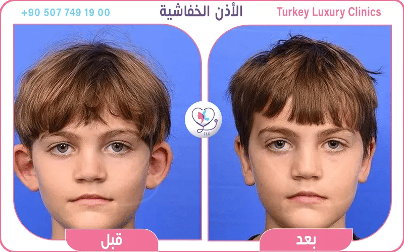 عملية تجميل الأذن (Otoplasty)