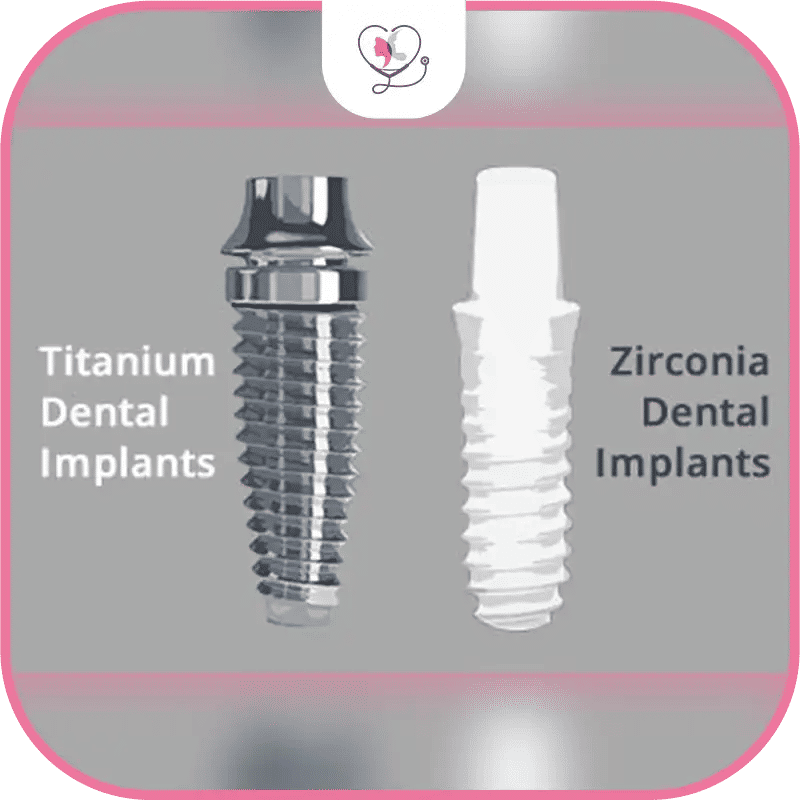 Types of Dental Implants Materials