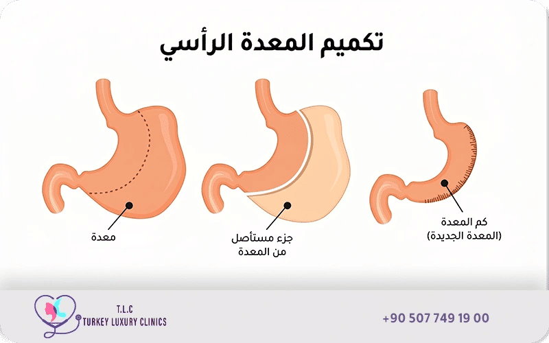 صورة توضح شكل المعدة بعد التكميم