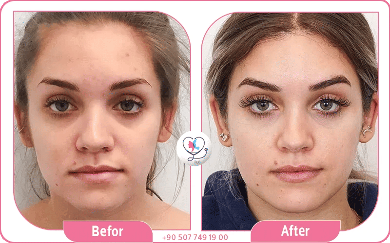 العوامل المؤثرة على سعر عملية رفع الحواجب