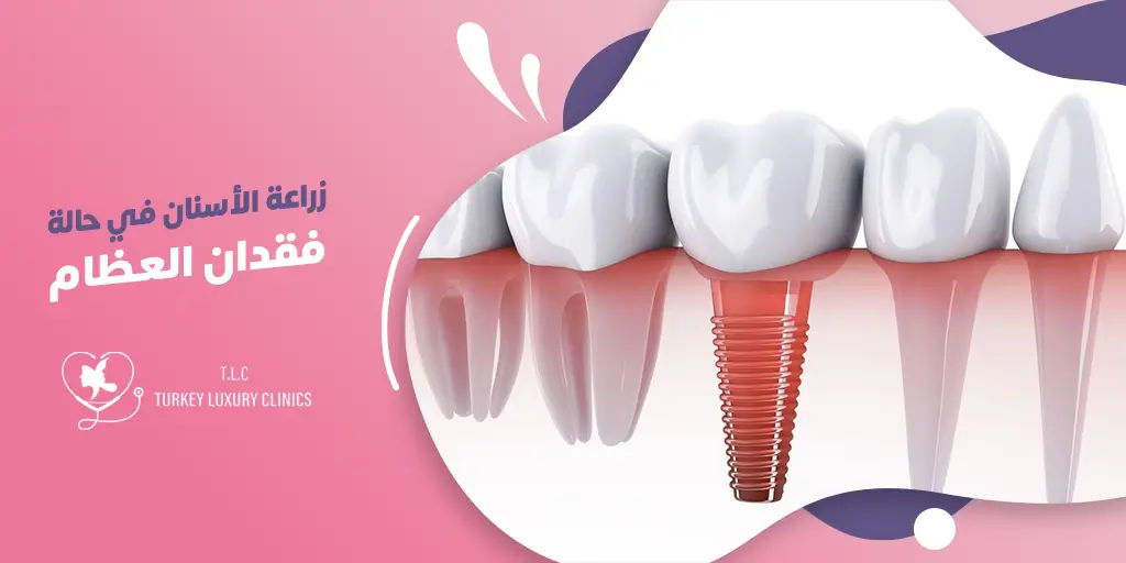زراعة الأسنان في حالة فقدان العظام