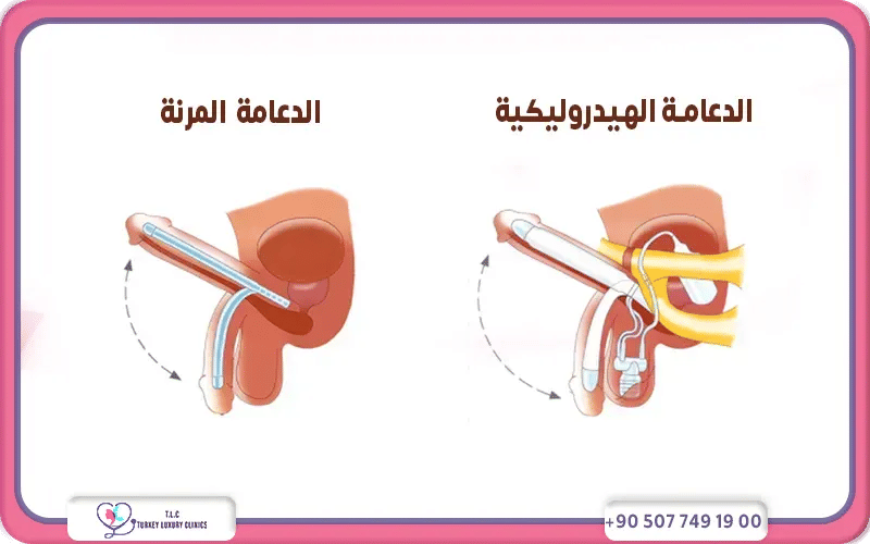 معايير اختيار دكتور دعامات للعضو الذكري