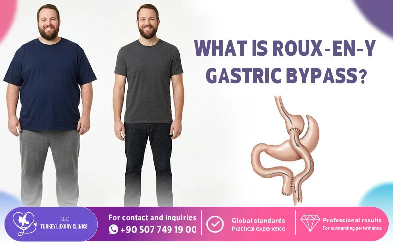 What Is Roux-en-Y Gastric Bypass?