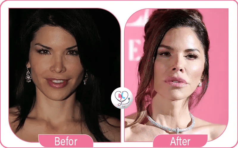 Visual transformation of Lauren Sánchez highlighting cosmetic enhancements.