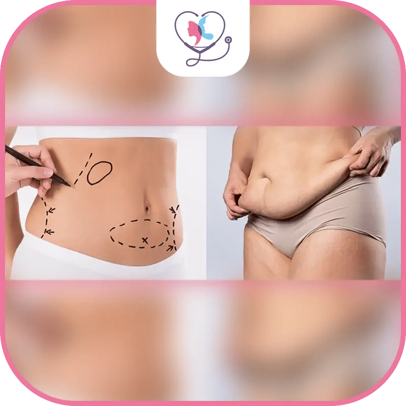 هل تختلف مدة عملية شد البطن بين الرجال والنساء؟