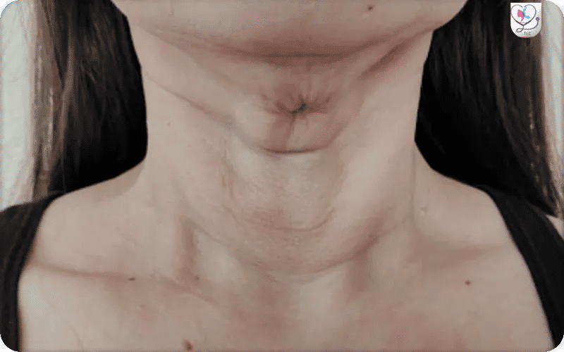 chirurgie plastique ratée photos-3