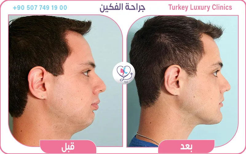 جراحة الفكين قبل وبعد