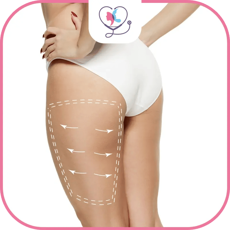 جراحة شد الفخذين في تركيا