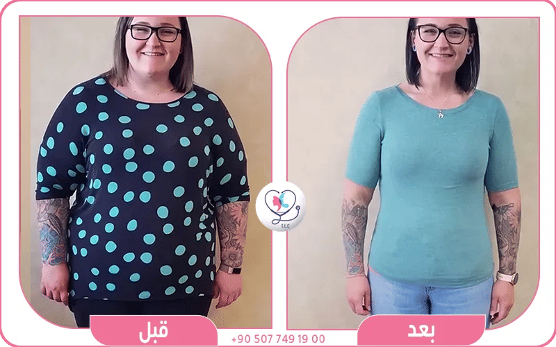 أضرار عملية تحويل المسار لمرضى السكر