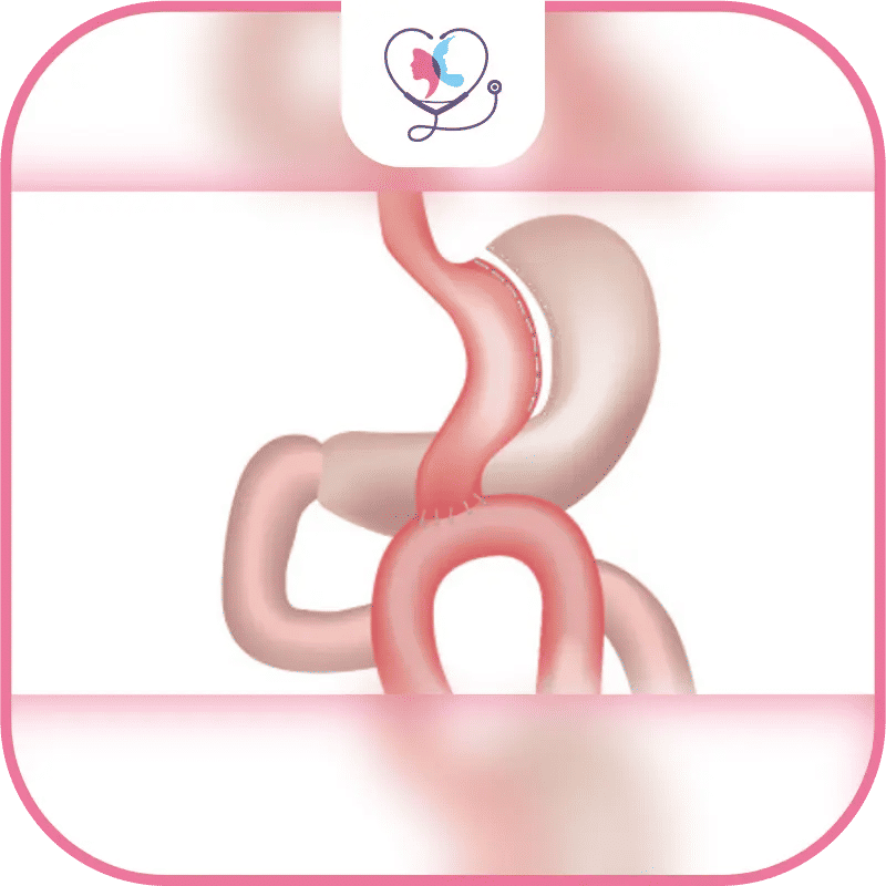 Le mini bypass : Une solution contre l'obésité