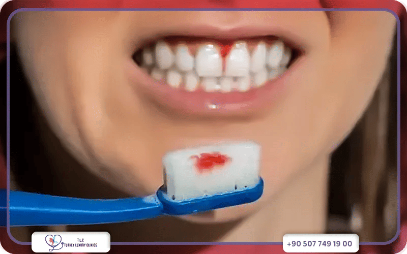 3. تفريش الأسنان بطريقة خاطئة