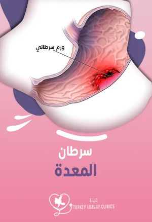 سرطان المعدة: أسبابه أعراضه علاجه في تركيا