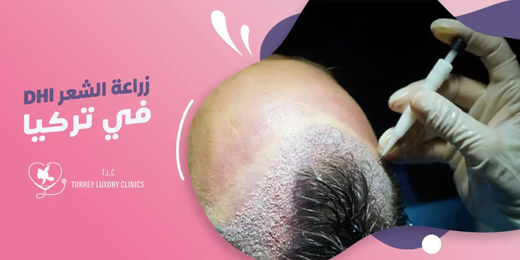 ماهي زراعة الشعر DHI في تركيا؟