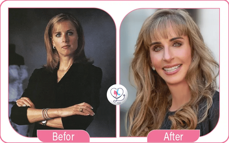 Susan Dell Before and After Plastic Surgery