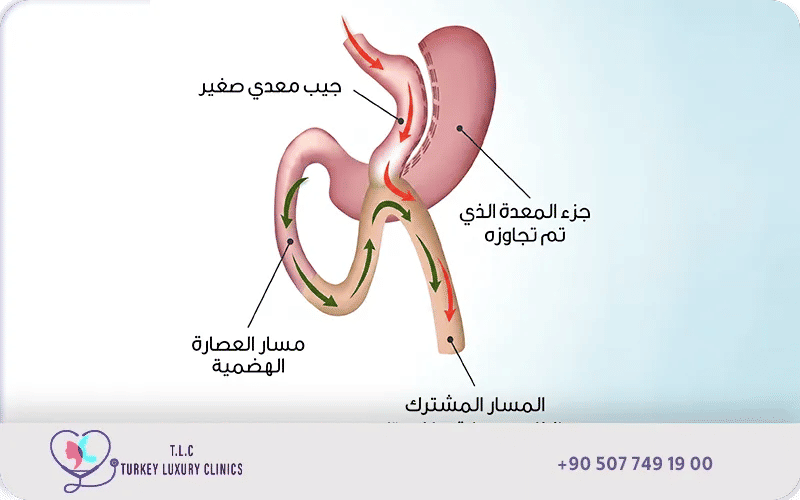 ما هي عملية تحويل مسار المعدة