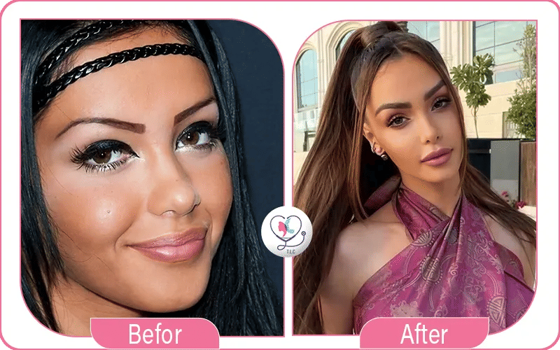 Nabilla sans chirurgie