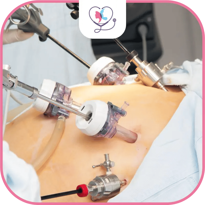 sleeve gastrectomie par laparoscopie