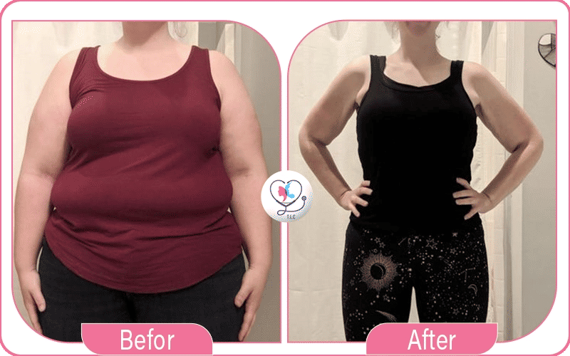 تجربتي مع بالون المعدة: خسرت 25 كيلو في 4 أشهر