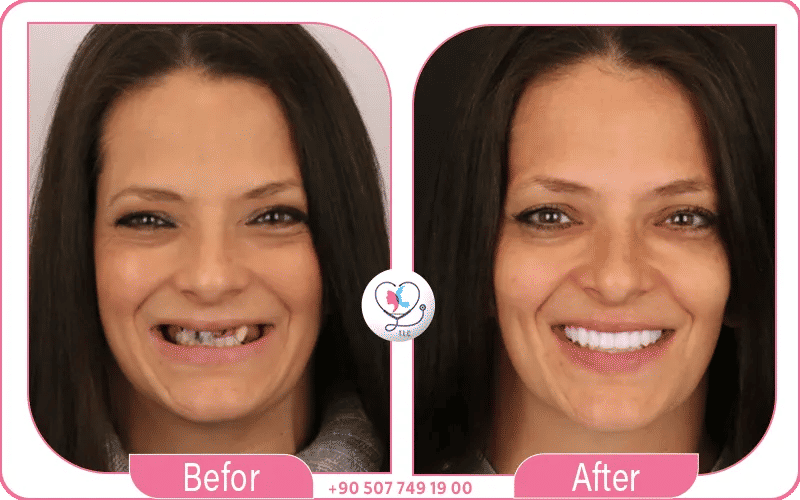 bridge implant dentaire avant après