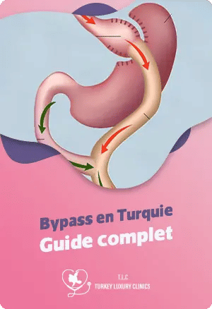 Bypass en Turquie : Guide complet