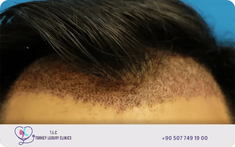 ما هي زراعة الشعر بدون حلاقة؟ ما هي زراعة الشعر بدون حلاقة؟