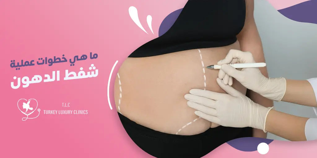 ما هي خطوات عملية شفط الدهون؟