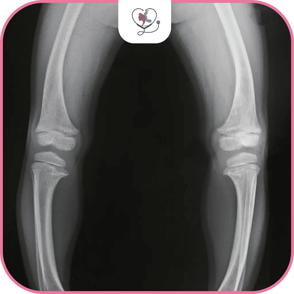 تقوس الساقين