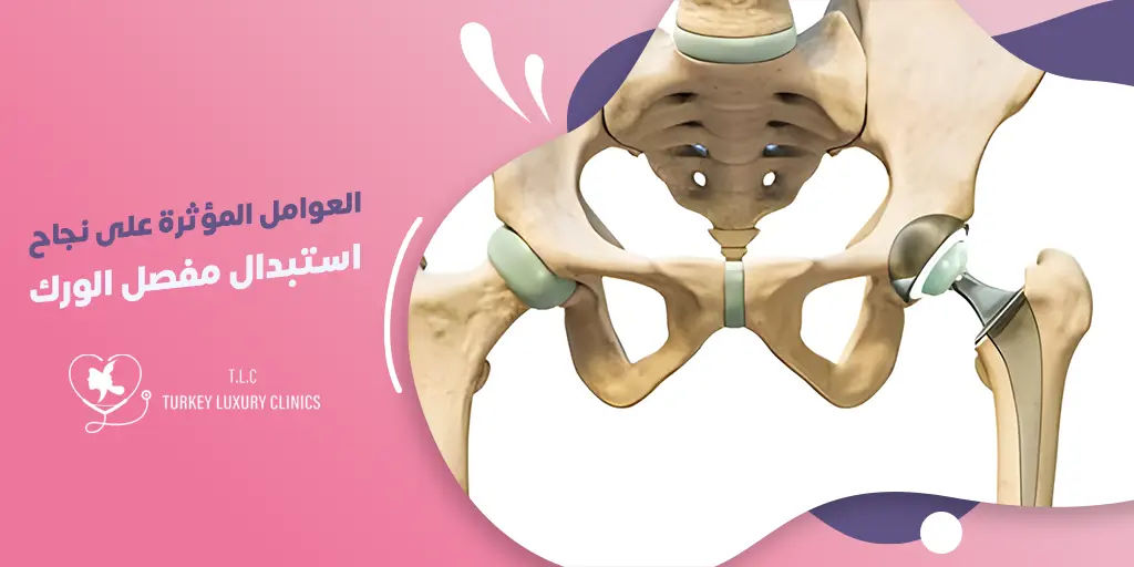 العوامل المؤثرة على نجاح استبدال مفصل الورك