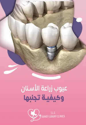 عيوب زراعة الأسنان وكيفية تجنبها دليل شامل 2026