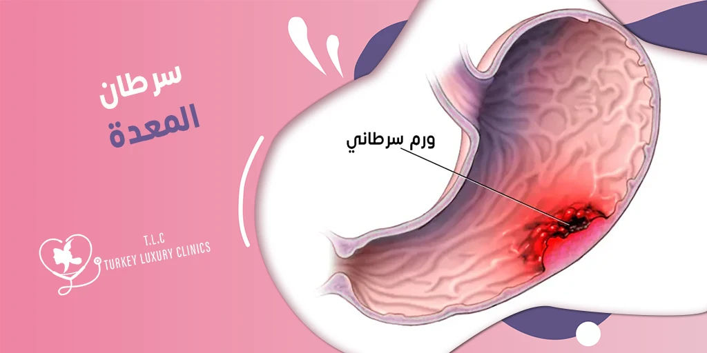 سرطان المعدة: أسبابه أعراضه علاجه في تركيا