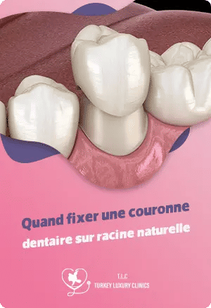 Quand fixer une couronne dentaire sur racine naturelle ?