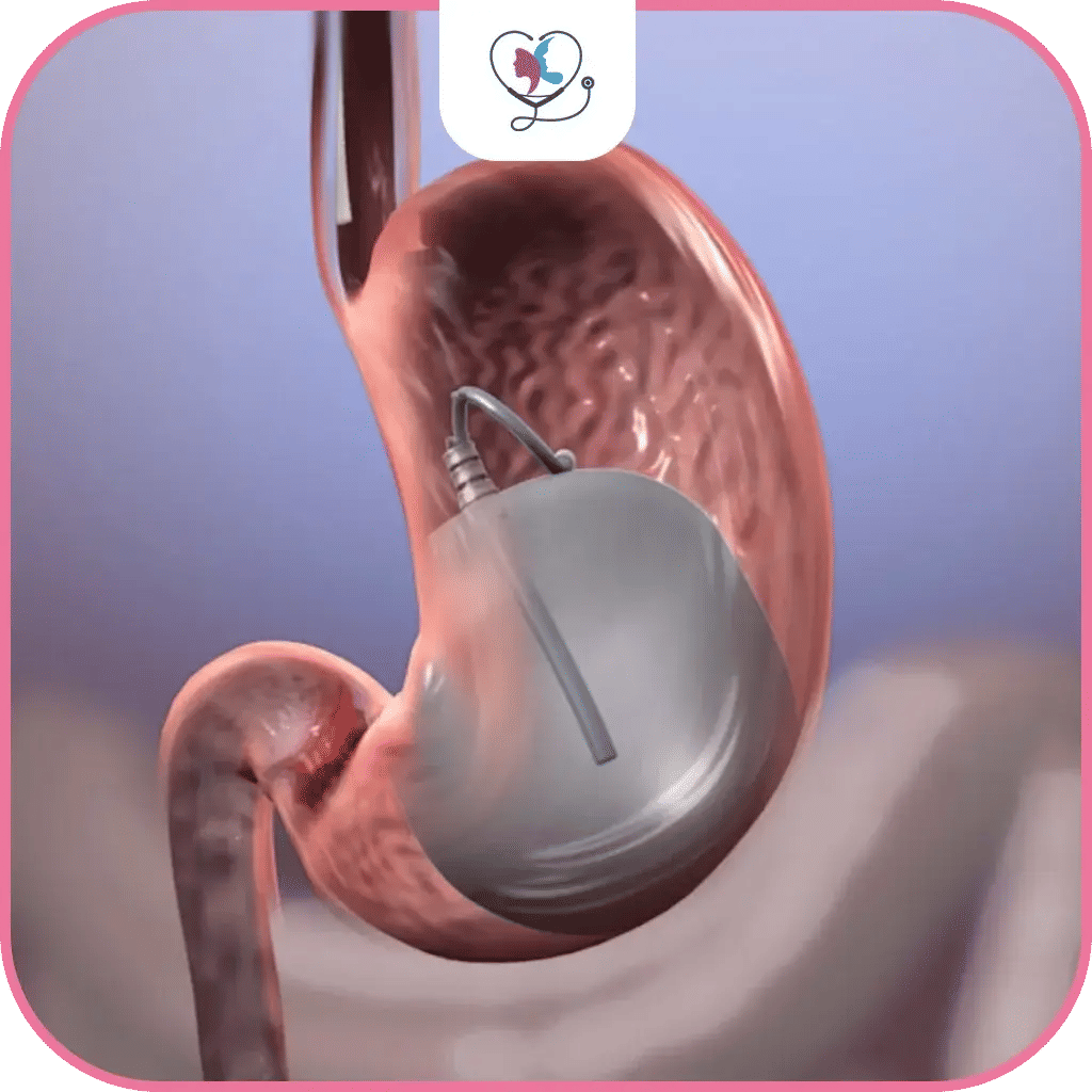 خطوات عملية بالون المعدة في تركيا