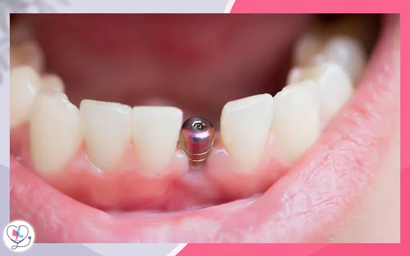 Single-Tooth Dental Implant