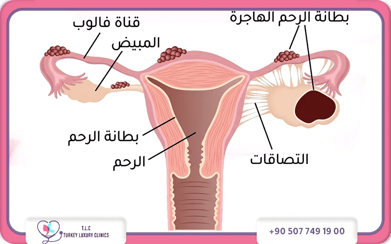 اعراض بطانة الرحم المهاجرة بحسب الموقع
