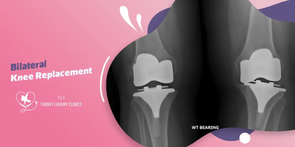 Bilateral Knee Replacement