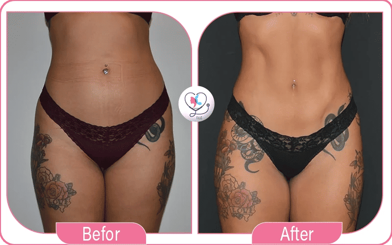 liposculpture avant après