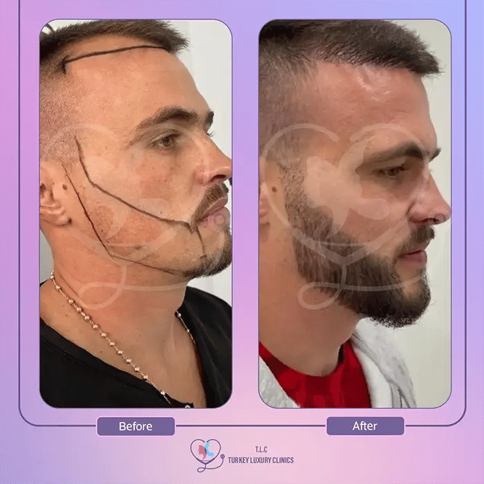 Beard Transplant Before and After in Turkey 3