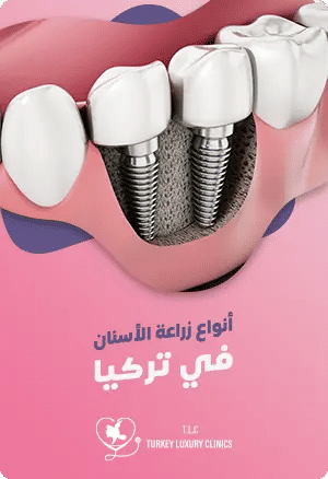  ما هي أنواع زراعة الأسنان في تركيا؟featured image