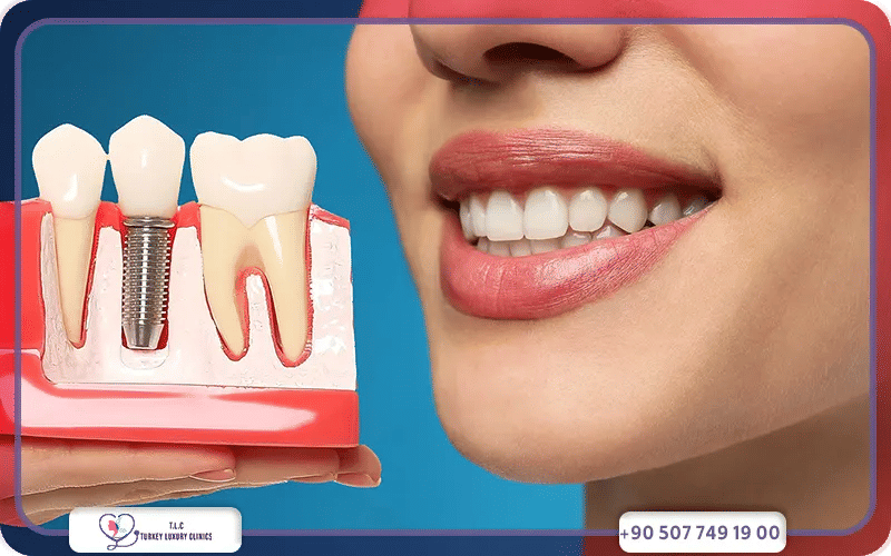 Comparaison du prix moyen d’ un implant dentaire à Paris vs Istanbul ?