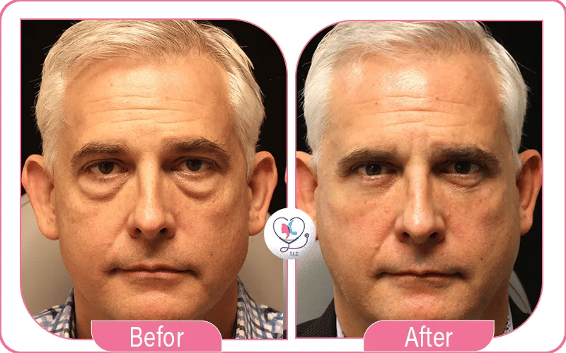 Pourquoi choisir turkey luxury clinic pour blépharoplastie laser