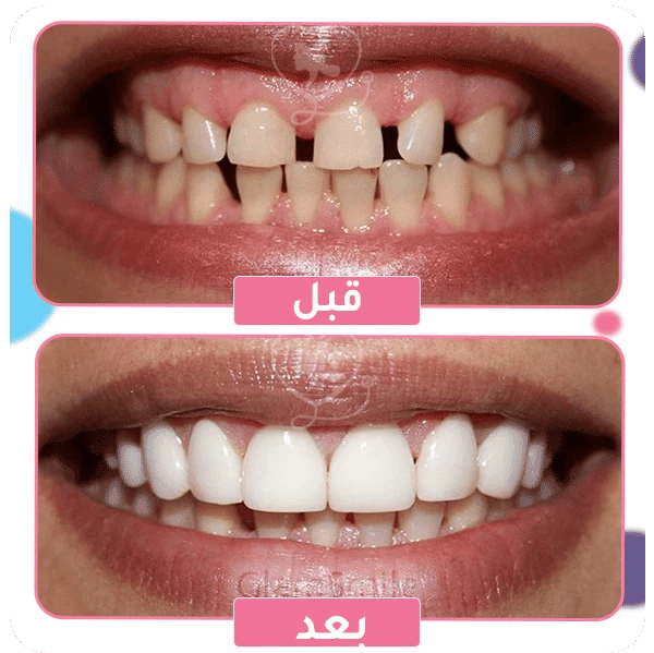 ما هو سناب اون سمايل