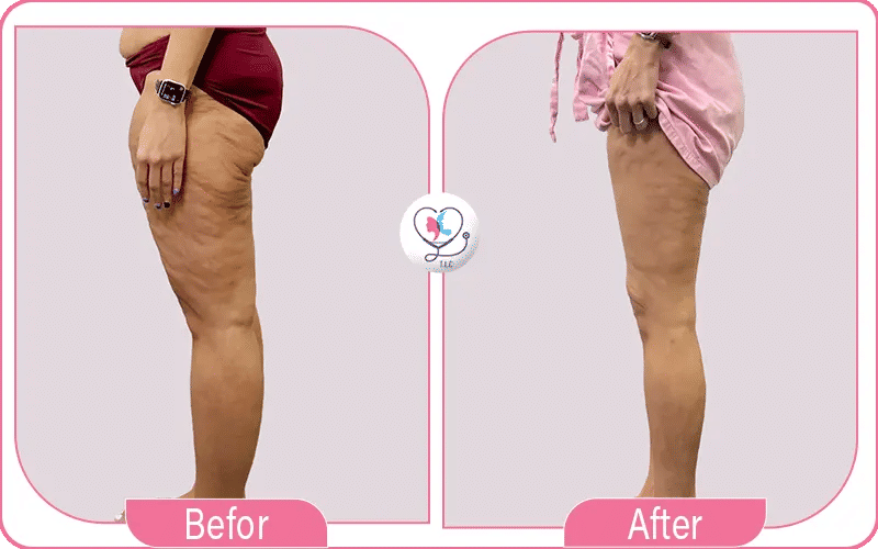 تجربتي مع عملية شد الأفخاذ 3