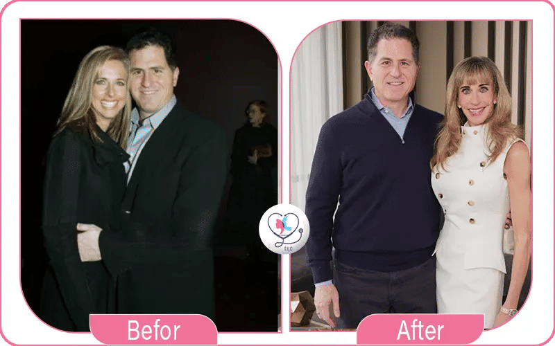 Susan Dell Before Plastic Surgery Pictures Analysis