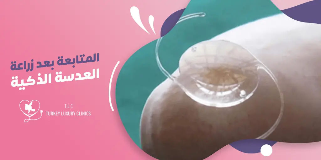 المتابعة بعد زراعة العدسة الذكية: متى يجب الاتصال بالطبيب؟