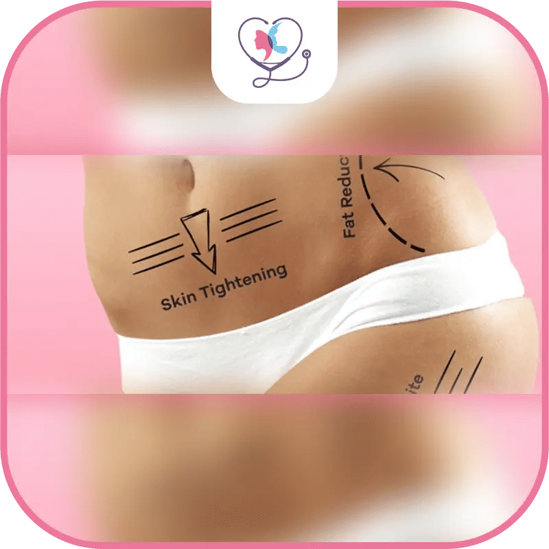 Qui peut bénéficier de la liposuccion par radiofréquence ?